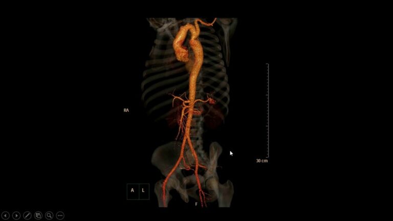 Coarctação de Aorta: Diagnóstico e Tratamento