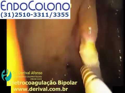 Ectasias Vasculares: O Que São?
