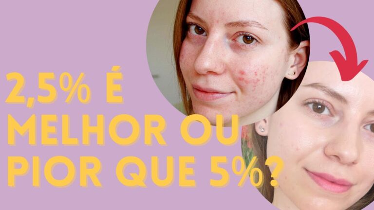 Eficácia do Peróxido de Benzoíla a 5% no Tratamento da Acne