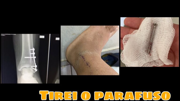 Retirada de Parafuso do Tornozelo: Opções de Anestesia