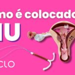 Alimentos ideais para sonda de gastrostomia