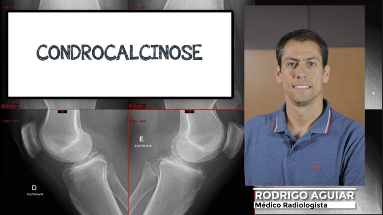 Condrocalcinose no Joelho: Causas, Sintomas e Tratamento