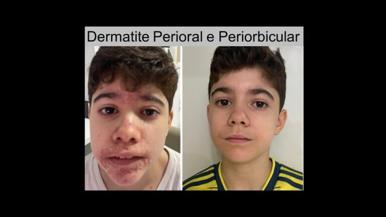 Os melhores especialistas em dermatite perioral: Conheça os especialistas mais renomados na área