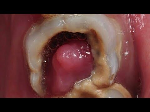 Como Remover Polipo do Dente de Forma Eficiente