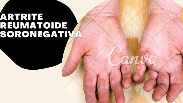 Sintomas da Artrite Reumatoide Soronegativa