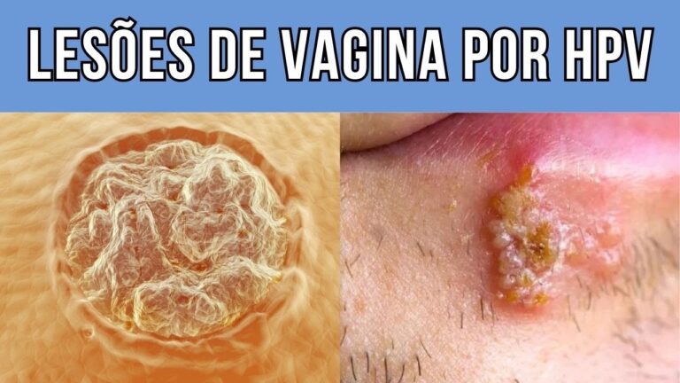 Lesões na vagina: Causas, Sintomas e Tratamentos