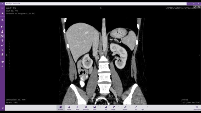 Veia Cava Inferior: Fun&ccedil;&atilde;o e Import&acirc;ncia no Corpo Humano