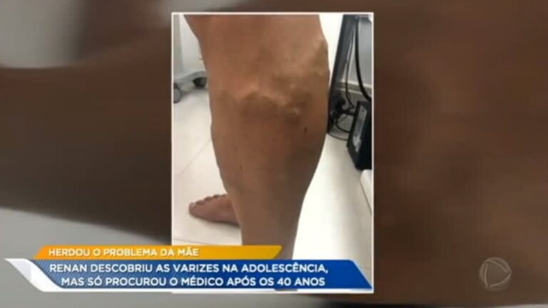 Guia Completo sobre Cirurgia de Veia da Perna