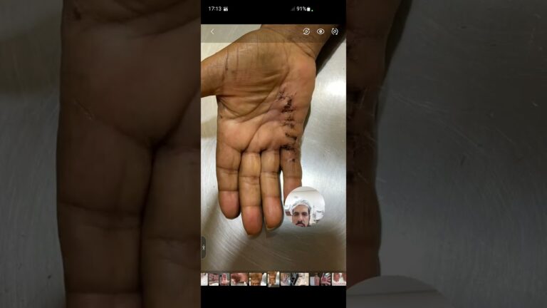 Fotos da Doença de Dupuytren: Um Guia Visual Completo