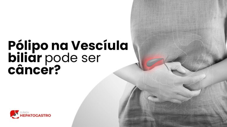 Pólipo na Vesícula Biliar: O Que Você Precisa Saber