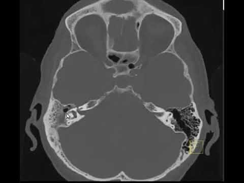 Otomastoidite: Entenda o que é e como tratar