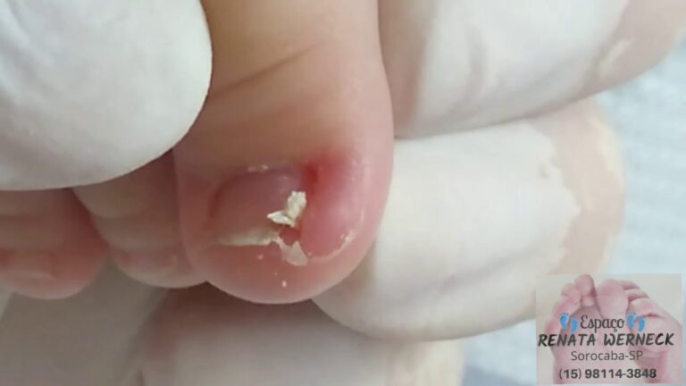 Como Tratar Unhas de Bebê Encravadas de Forma Eficaz