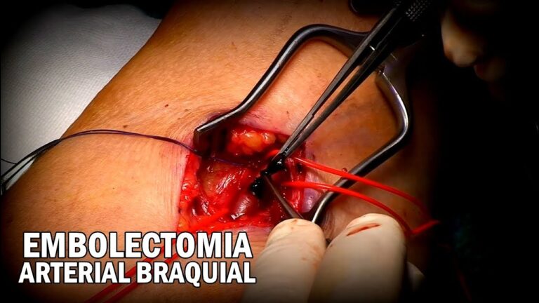 Embolectomia: entenda o procedimento e seus benefícios.