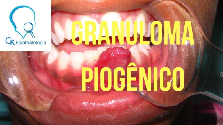 Granuloma Piogênico na Boca: Causas e Tratamentos