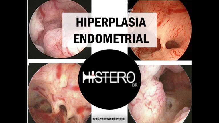 Relação entre Hiperplasia Endometrial e Câncer: O Que Você Precisa Saber