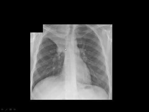 Atelectasia Pulmonar: Causas e Tratamentos Eficazes