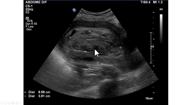 Tratamento de Hematoma Pós Cesárea