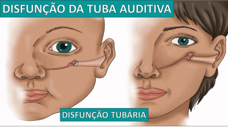Disfunção Tubária: Causas e Tratamentos