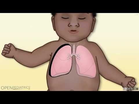 Pneumotórax em Recém-Nascidos: Causas e Tratamentos