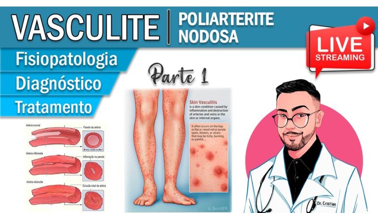 Poliarterite Nodosa Cut&acirc;nea: Uma Revis&atilde;o Abrangente