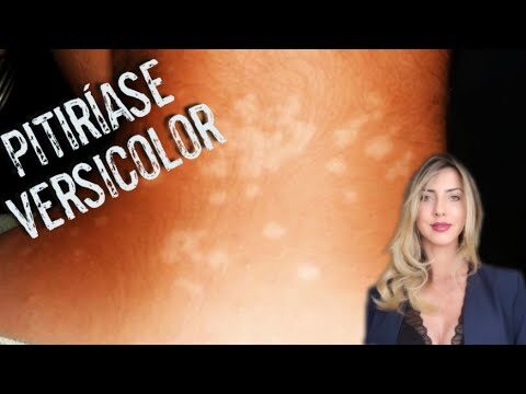 Pitiríase Versicolor: Causas, Sintomas e Tratamentos