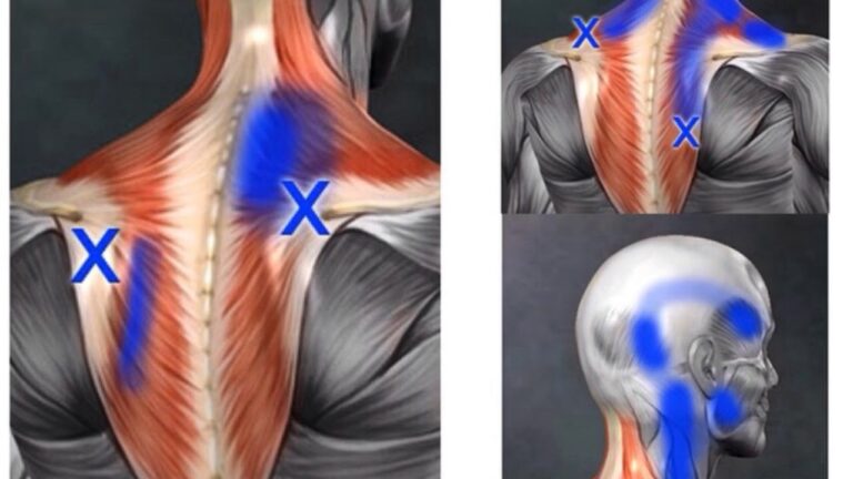 Tratamento eficaz para cefaléia cervicogênica