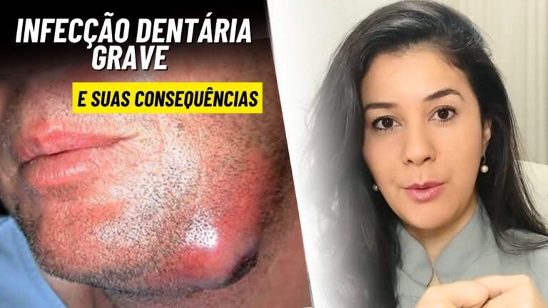 Sintomas da angina de Ludwig: Conheça os sinais de alerta