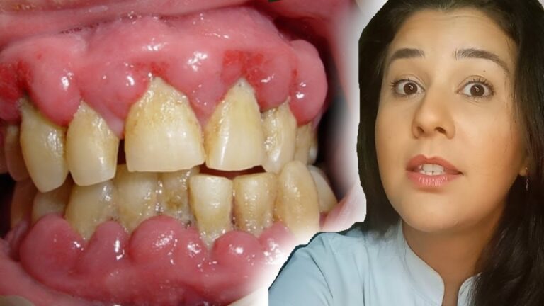 Edema Gengival: Causas e Tratamentos