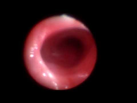 Estenose Subglótica: Causas, Sintomas e Tratamento