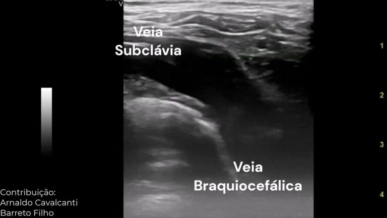 Anatomia da Veia Subclávia: Um Guia Completo