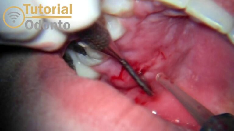 Abscesso Periodontal: Imagens e Diagnóstico