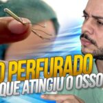 Implante Coclear: Tecnologia e Benefícios