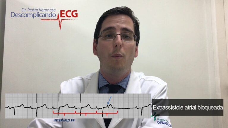 Sístole Atrial Extra: O Que Você Precisa Saber