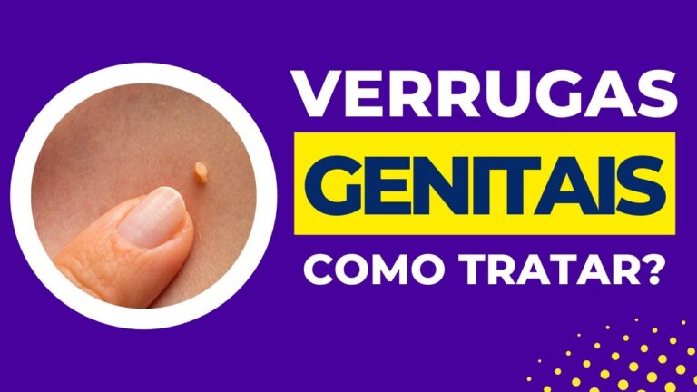 Melhor pomada para verrugas genitais: guia completo