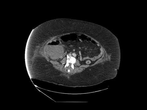 Guia Completo sobre Abscesso Intra-Abdominal