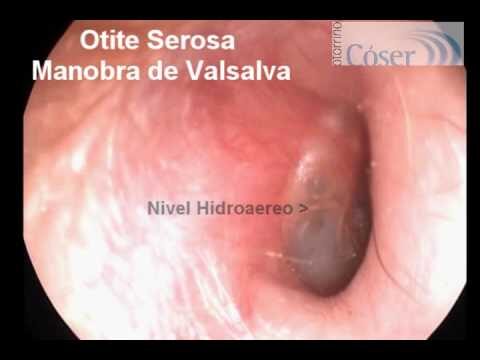 Membrana Timpanica Hiperemiada: Causas e Tratamentos