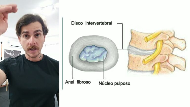 Redução do Espaço Discal L5-S1: Causas e Tratamentos Eficazes