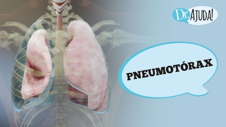 Classificação e Tipos de Pneumotórax