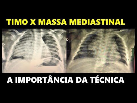 Análise Completa de Timo: Raio X e Funcionamento