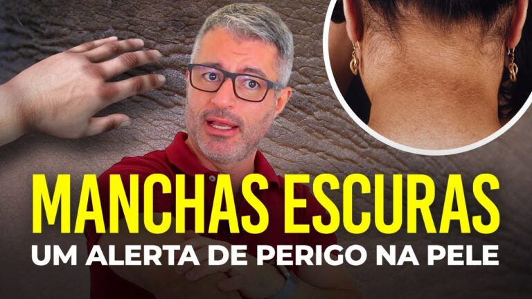 Especialistas em Acantose Nigricans: Diagnóstico e Tratamento Eficazes