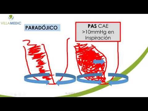 Taponamento Cardíaco: Causas, Sintomas e Tratamento