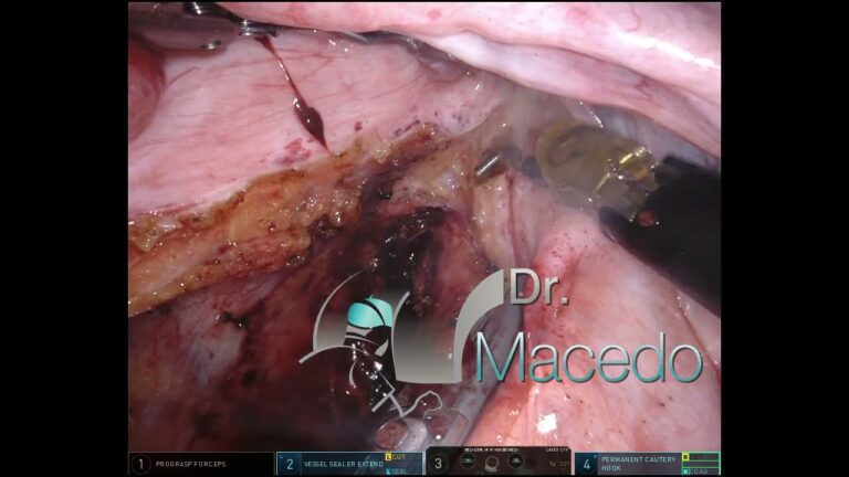 Amputação abdominoperineal: o que você precisa saber