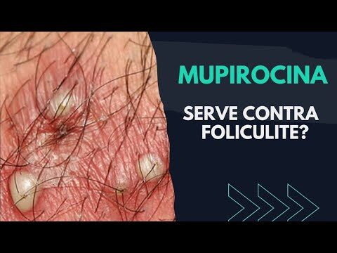 Mupirocina: O Que É e Para Que Serve?