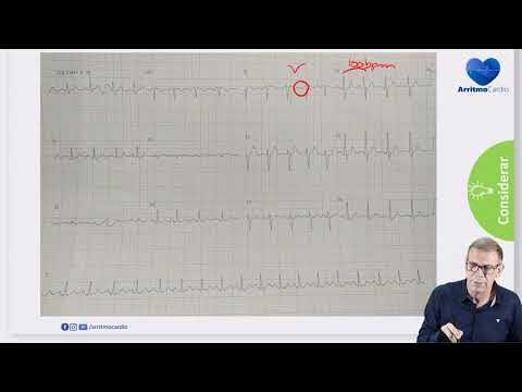 Onda U no Electrocardiograma: Significado e Importância