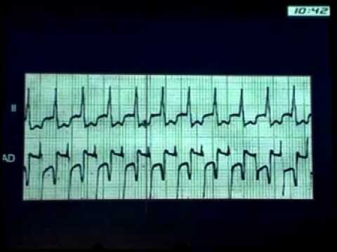 Entenda a Arritmia Supraventricular: Causas e Tratamentos