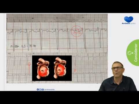 Taquicardia Atrial: Interpretação do ECG