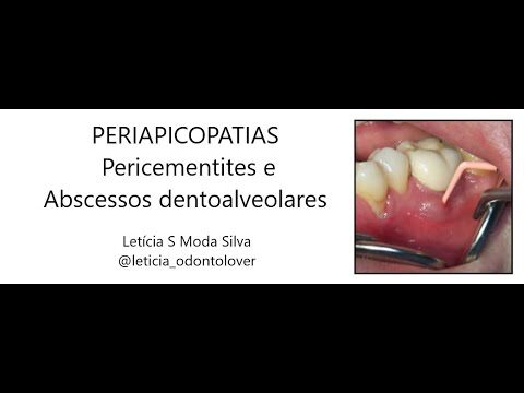 O que é a periapicopatia: explicação concisa