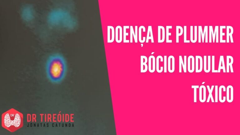 Adenoma Tóxico: Causas, Sintomas e Tratamentos