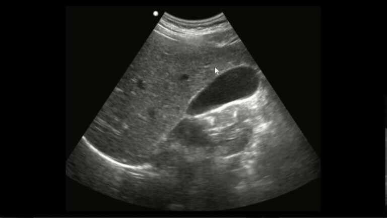 Ultrassom para pedra na ves&iacute;cula: diagn&oacute;stico preciso.