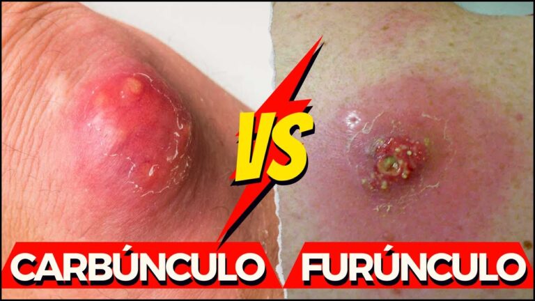 Entenda a diferença entre furúnculos e carbúnculos